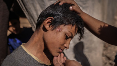 copil cu o boală de piele din Siria