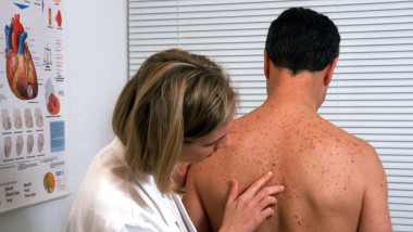Moderna şi Merck vor dezvolta un vaccin cu ARN mesager împotriva cancerului de piele