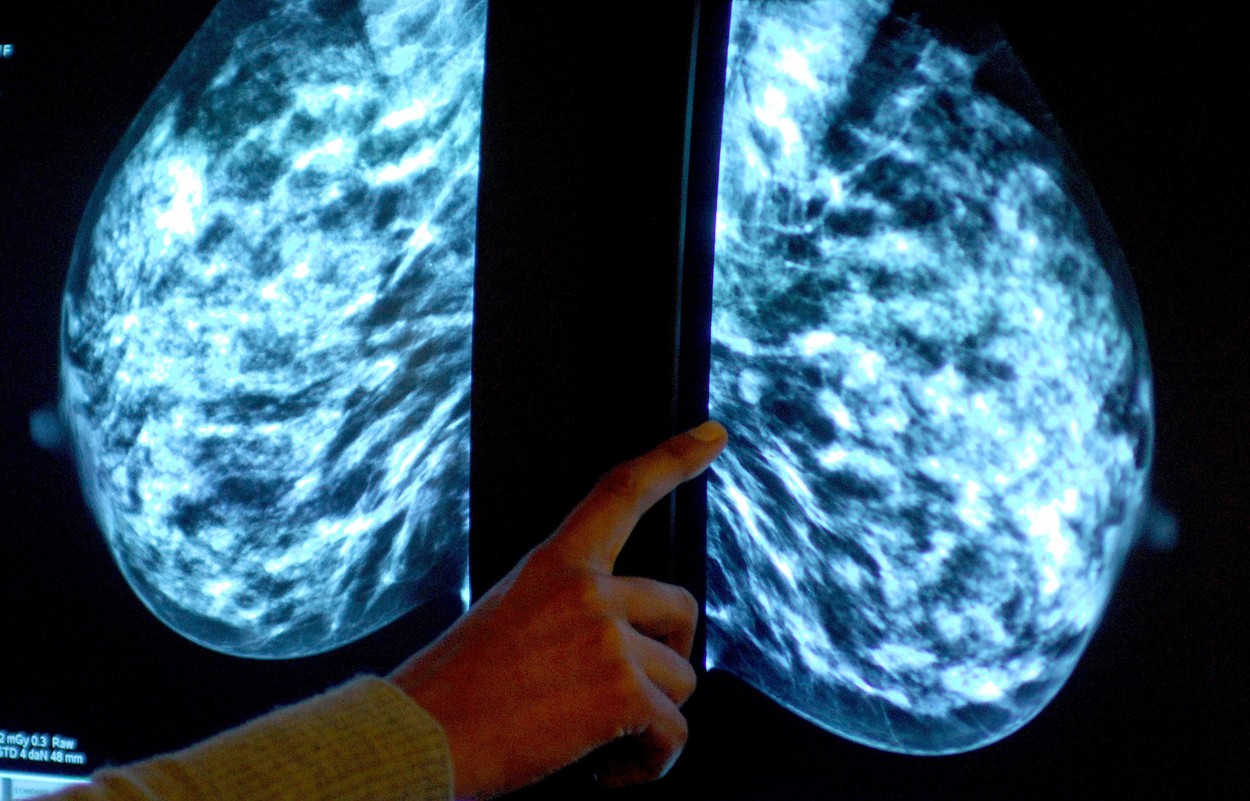 Europa se va confrunta cu o "epidemie de cancer", avertizează oncologii. Un milion de cazuri ar fi rămas nediagnosticate în pandemie