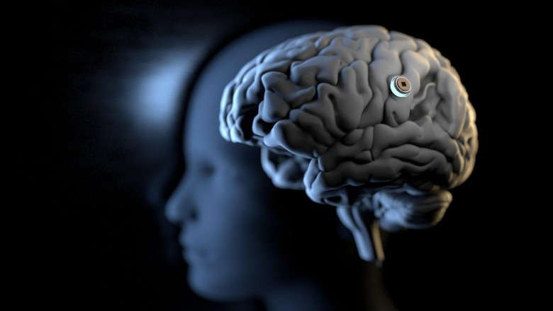 reprezentrare grafica a unui implant in creierul uman