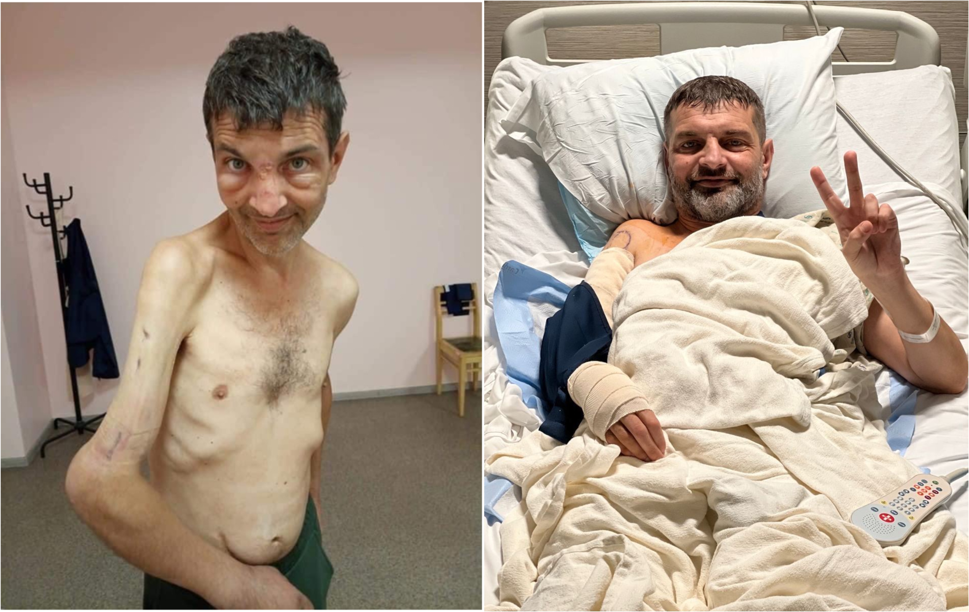 Cum arată luptătorul de la Azovstal căruia rușii i-au smuls cu clești dispozitivul care-i fixa brațul. Mihailo a fost operat în SUA
