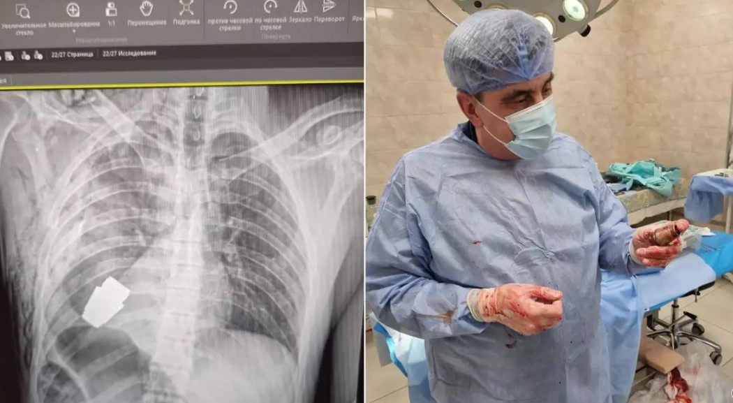 Un soldat ucrainean care avea în el o grenadă neexplodată a fost operat cu succes de medicii militari