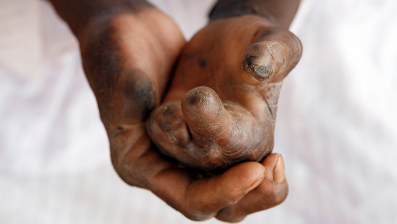Mâinile unui bolnav de lepră cu boala în stare foarte avansată.