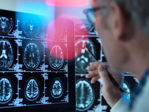 Un medicament pentru tratarea bolii Alzheimer în stadii timpurii este aproape de autorizare în UE. Ce este donanemab
