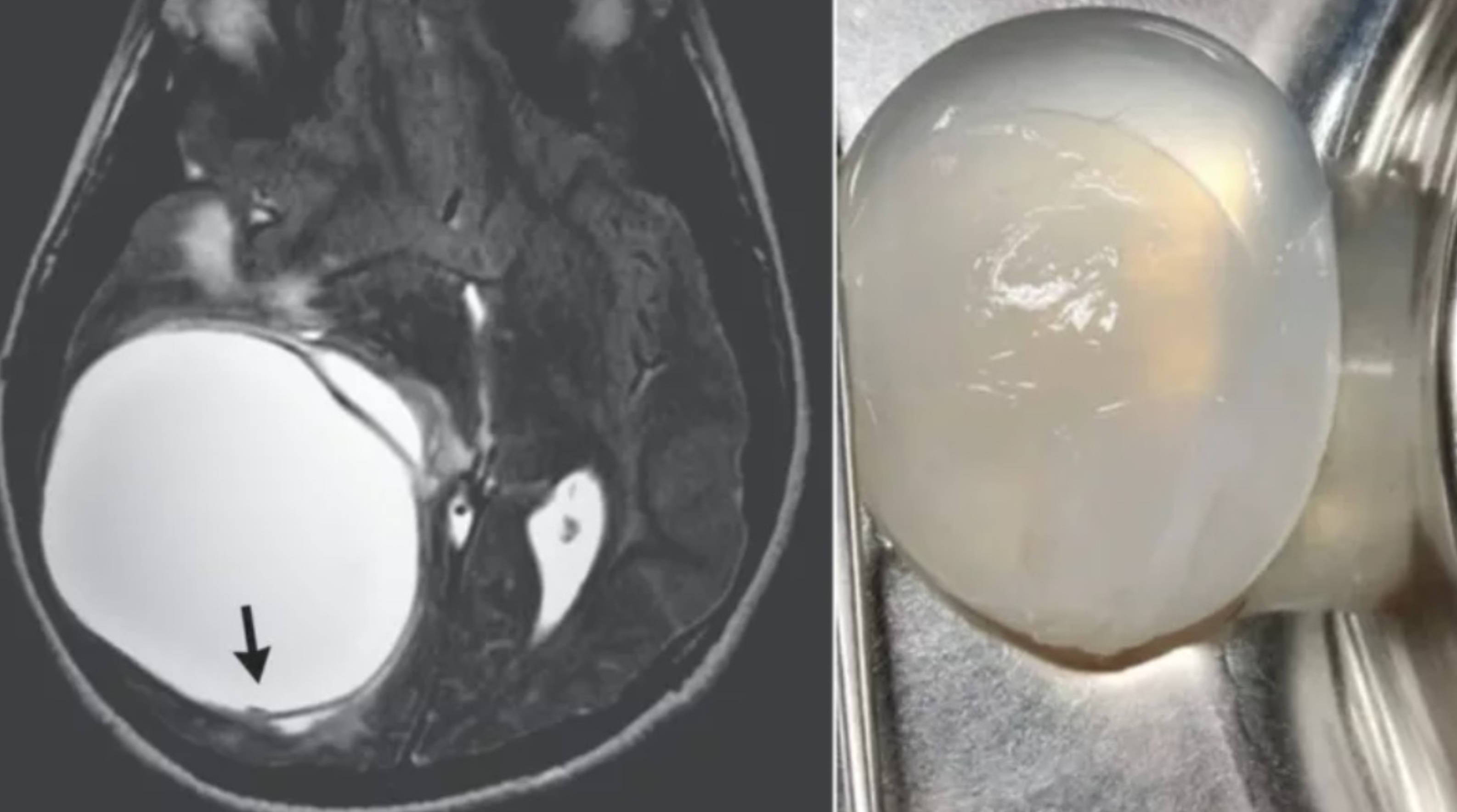Un băiat de 14 ani care acuza dureri de cap și stări de vomă avea o tumoare uriașă la creier provocată de viermii intestinali