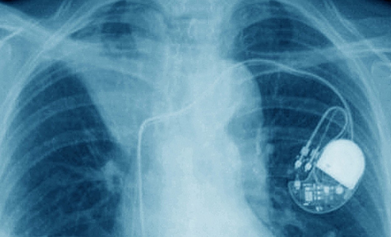 Ministerul Sănătății: Legislaţia interzice în mod explicit reutilizarea stimulatoarelor cardiace