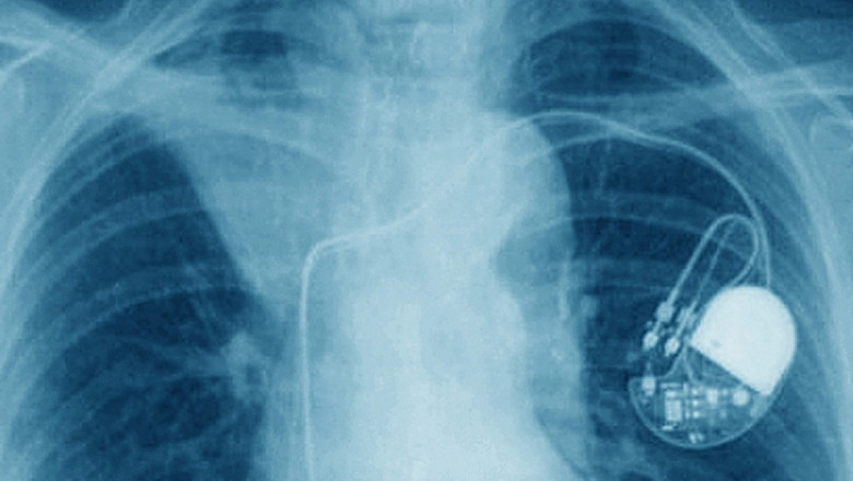 Pacemaker implanted in the chest. Frontal chest x-ray.
