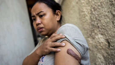 Domestic worker Kartika Puspitasari shows a scar on her arm from an injury inflicted by a previous employer