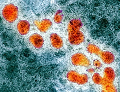 O fată de 11 ani infectată cu virusul gripei aviare H5N1 a murit, în Cambodgia. Simptomele care au anunțat boala