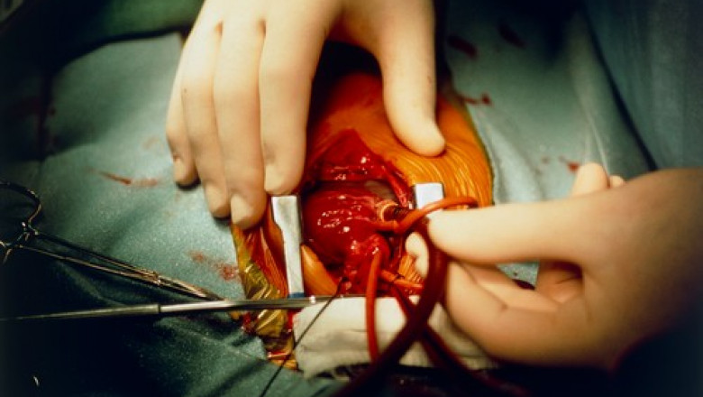 transplant de inima