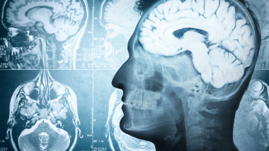 creier radiografie