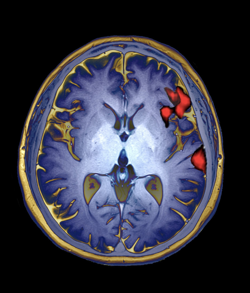Imagine RMN cu activitatea cerebrală a creierului uman