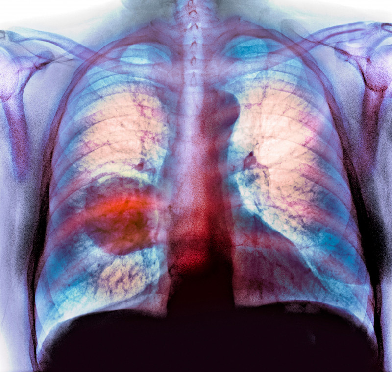 Lung cancer, X-ray