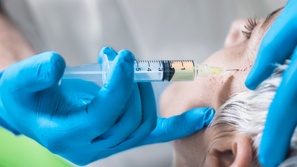 „Terapia-vampir”, una dintre cele mai căutate proceduri cosmetice, poate fi periculoasă. Un medic explică cum trebuie făcută