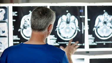 un medic se uita la radiografii ale unui creier