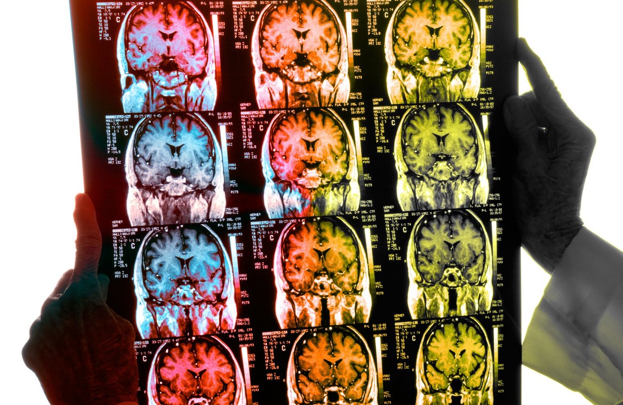 Un instrument bazat pe AI i-ar putea ajuta pe chirurgi să vindece cancerul cerebral