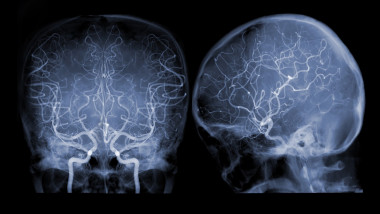 radiografie creier