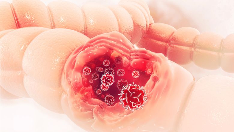 Tratamentul modern al cancerului colorectal, cea mai frecventă afecțiune oncologică diagnosticată în România