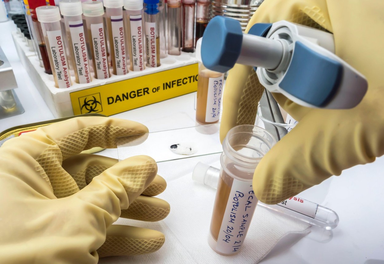 Alertă de botulism în vestul țării. Medicii au descoperit încă 3 cazuri, după ce 4 oameni au ajuns la spital