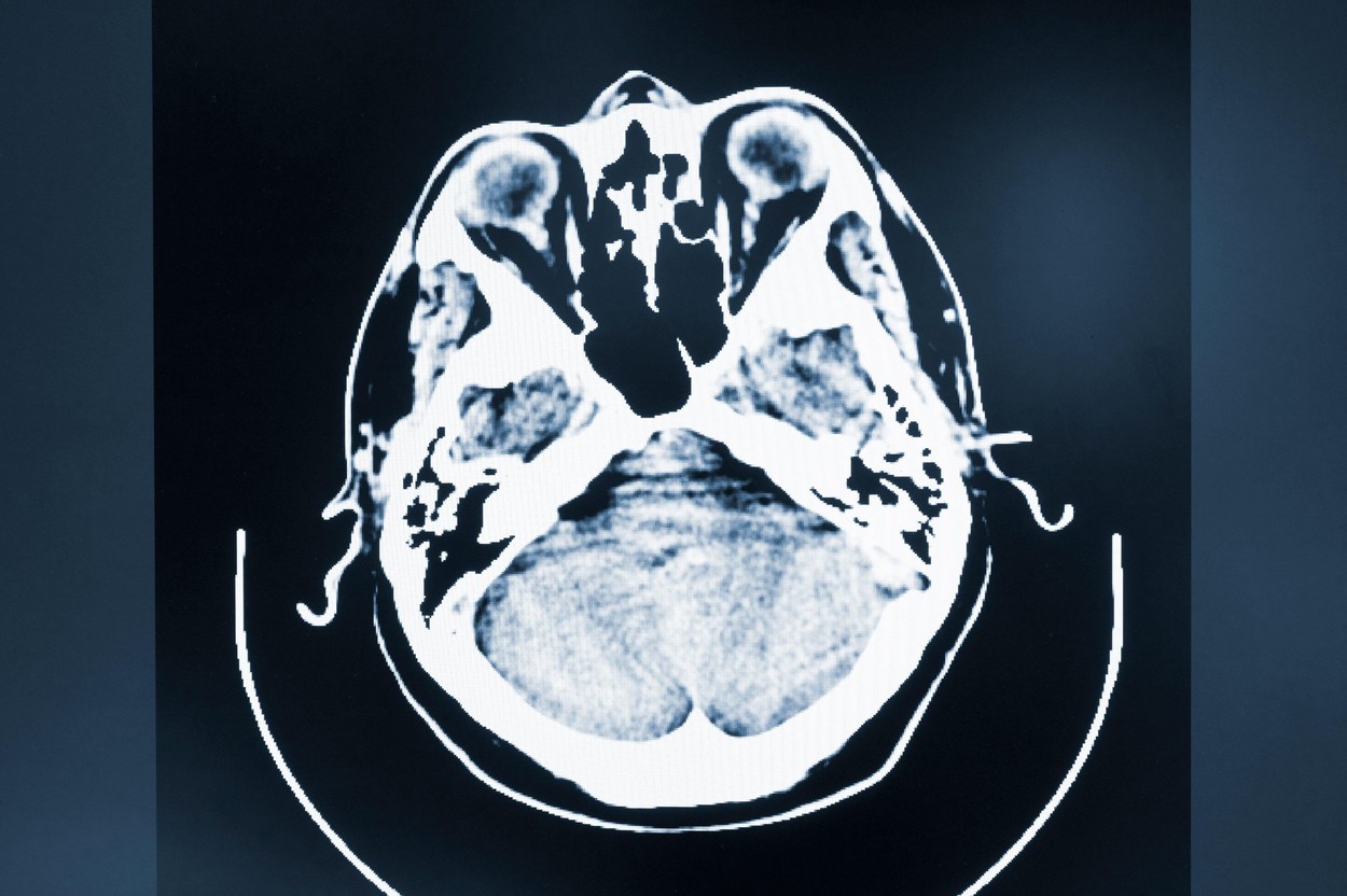Neuralink, compania lui Elon Musk, caută voluntari pentru a începe testele cu implanturi cerebrale pe oameni