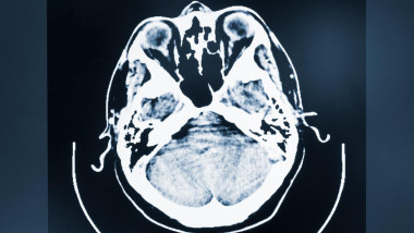 radiografie a creierului