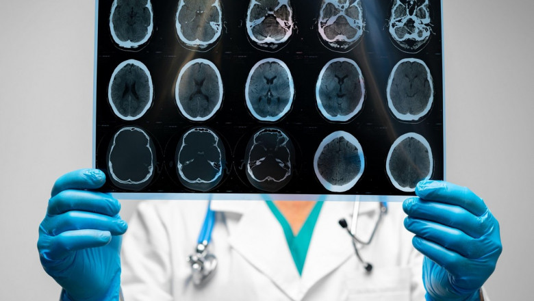 un medic se uita peste o radiografie a creierului