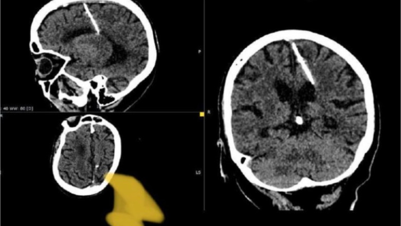 Radiografie în urma căreia s-a descoperit un ac de trei centimetri în creierul unei femei de 80 de ani din Rusia