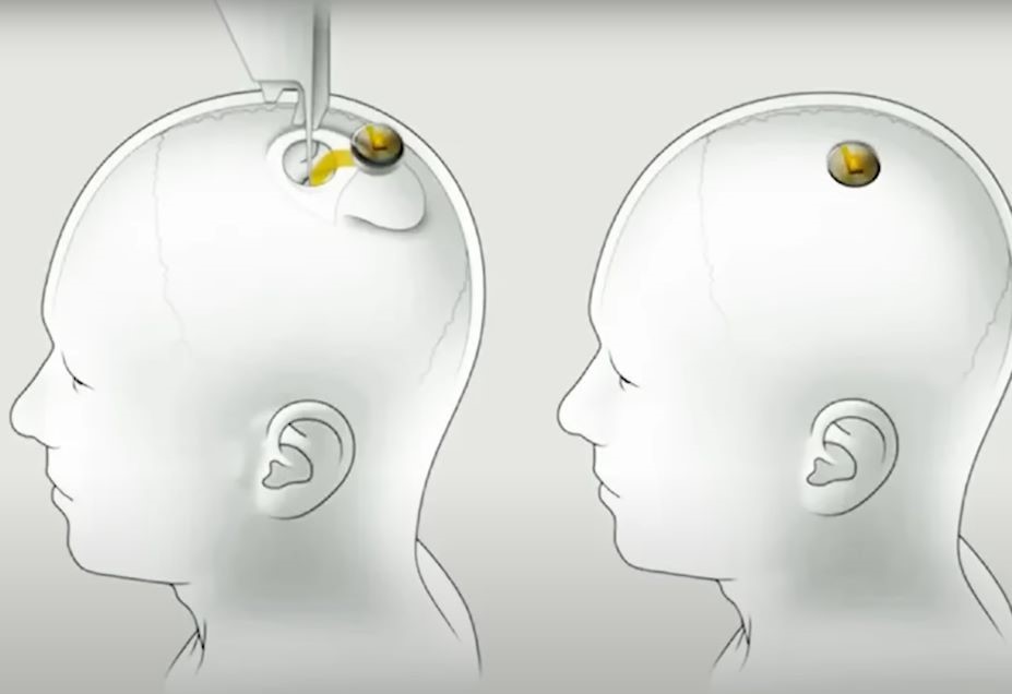 Mii de oameni vor un implant cerebral dezvoltat de compania lui Elon Musk, dar Neuralink nu găsește primul om care să fie testat