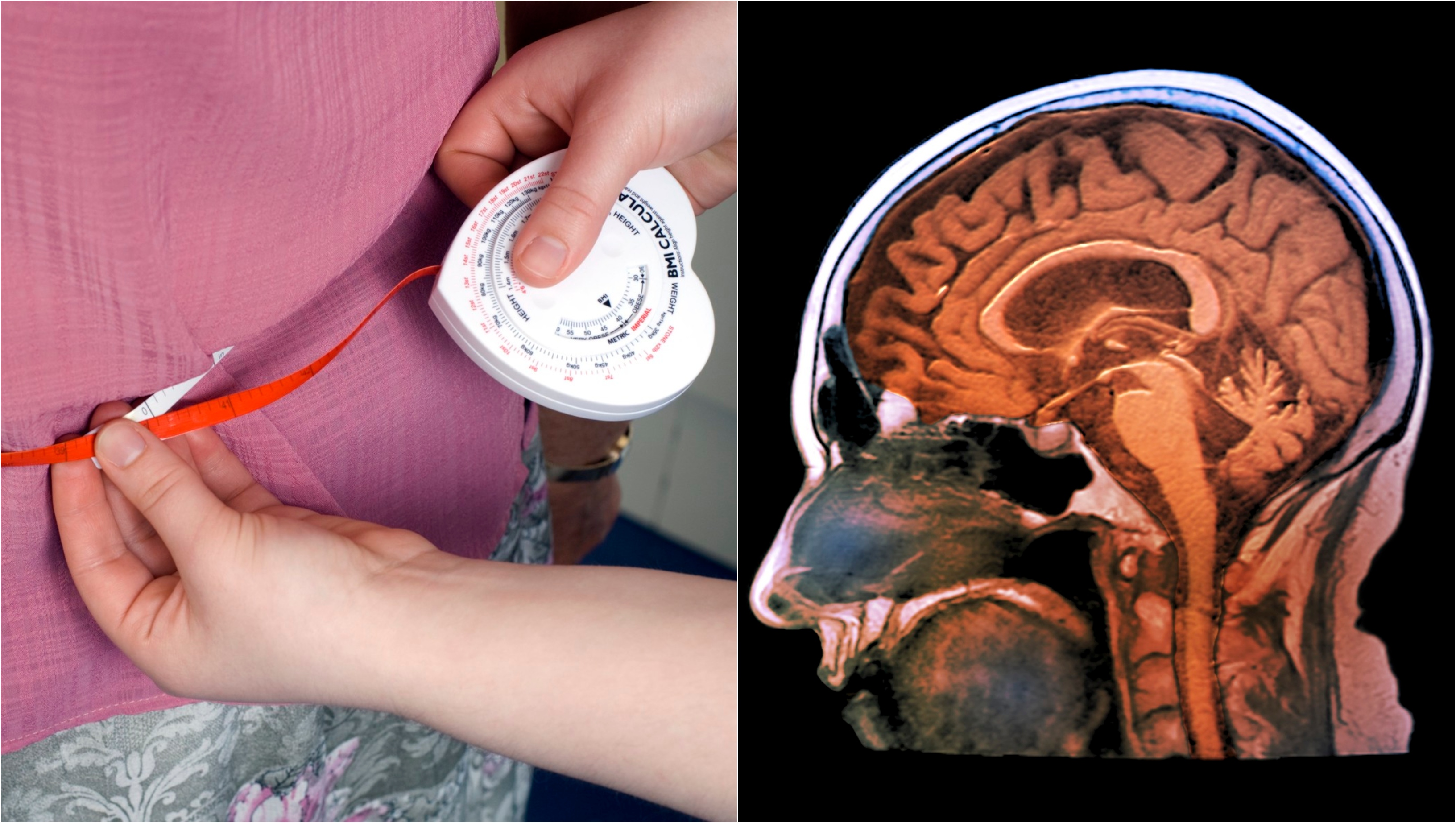 Grăsimea ascunsă din burtă poate fi primul semn de Alzheimer. Chiar și persoanele slabe sunt afectate