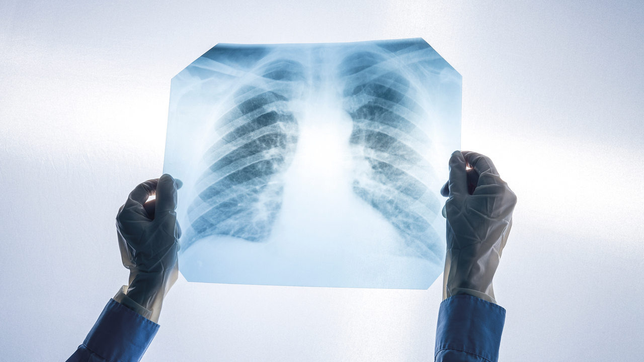 Screeningul pulmonar, o investigație esențială pentru fumătorii cu vârsta de peste 50 de ani