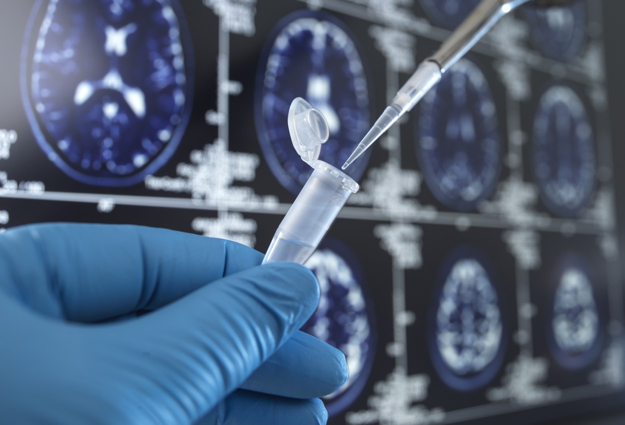 Descoperire importantă. A fost găsită proteina care provoacă o formă de demență ce afectează oameni de 40-50 de ani