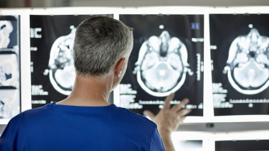 un medic se uita la radiografii ale creierului