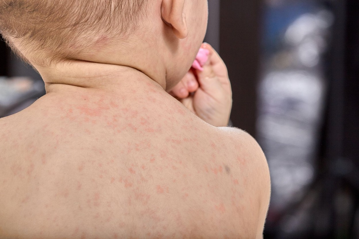 Peste 760 de cazuri noi de rujeolă, înregistrate în ultima săptămână. Un copil de 10 luni, din Bucureşti, a murit