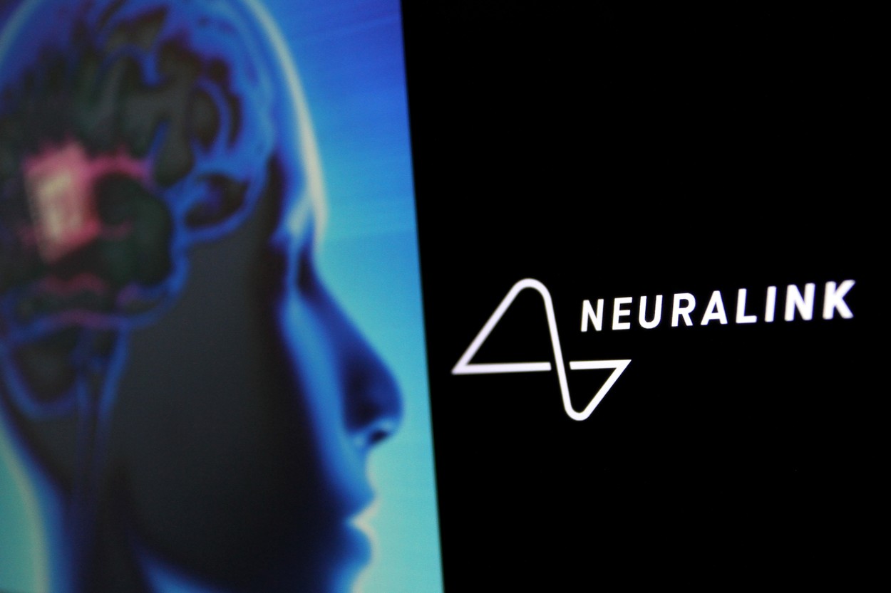 Primul implant cerebral anunțat de Musk i-a stârnit pe conspiraționiști. Cristian Presură: Aceste procese sunt încete, pașii sunt mici