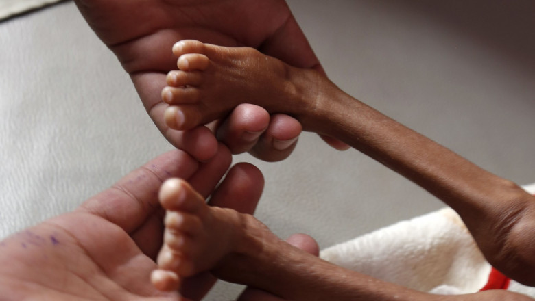 o persoana tine in maini picioarele unui bebelus malnutrit