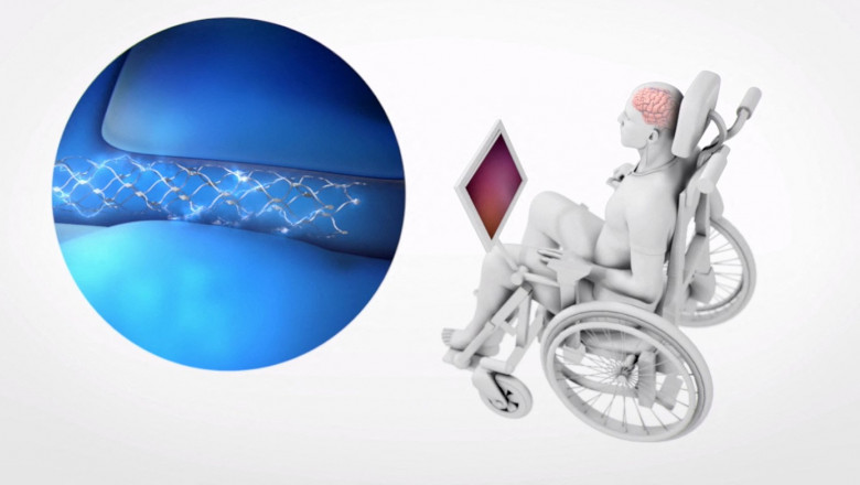 L'implant cérébral Stentrode destiné aux paralysés leur permettant de faire fonctionner des ordinateurs et des gadgets électroniques a été testé avec succès sur dix personnes.