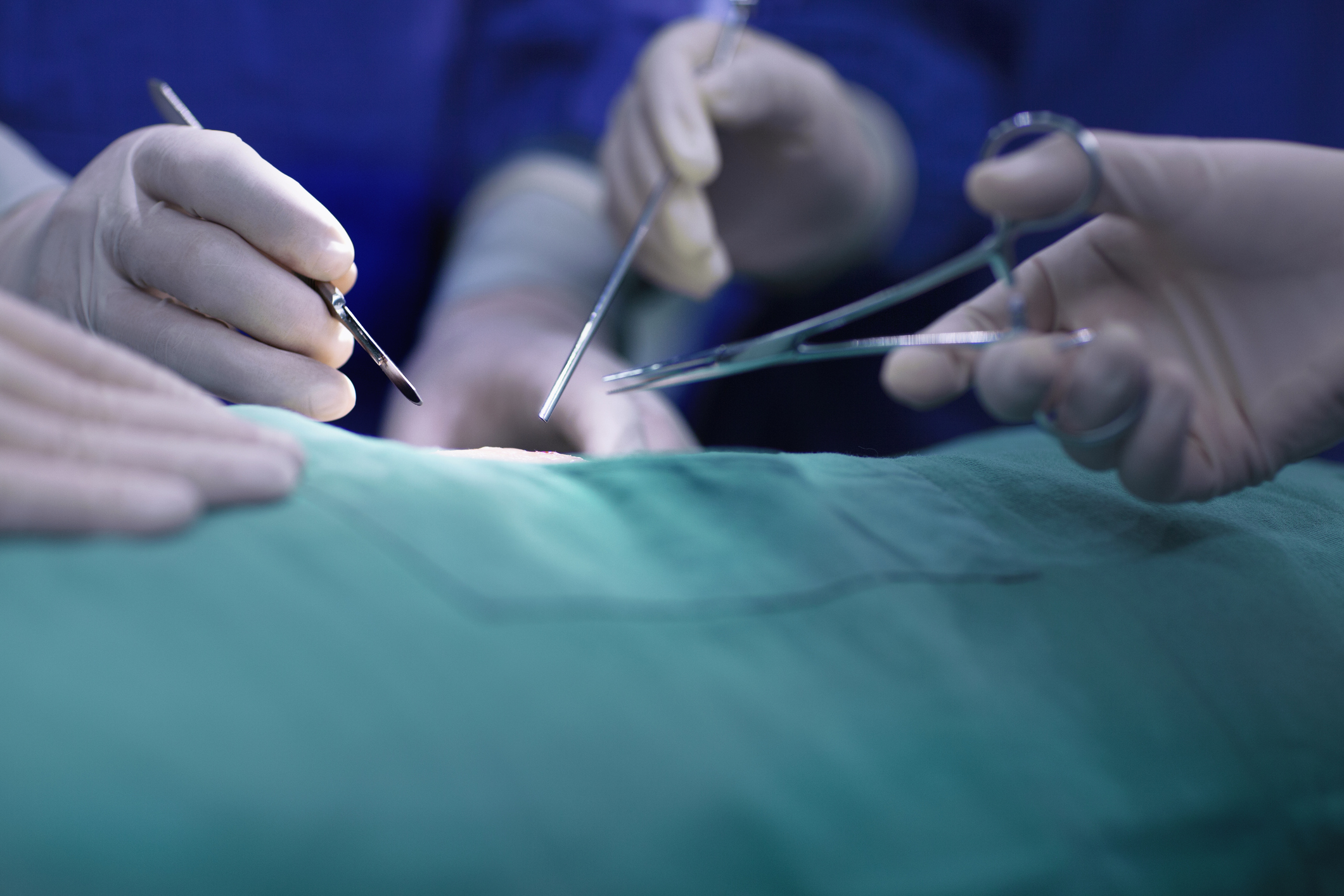 O tumoră de 45 de kilograme a fost scoasă din abdomenul unei femei din Botoșani, care a mers la medic când a văzut că se îngrașă brusc