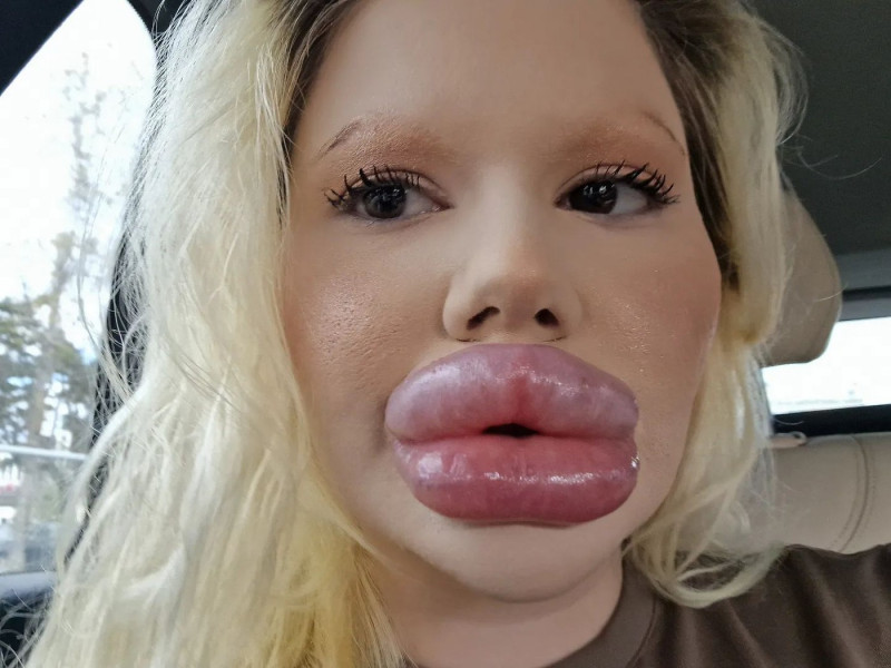 Woman with ‘world’s biggest lips’ gets filler on either side of nose to ‘even things out’