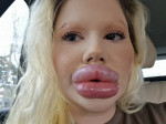 Woman with ‘world’s biggest lips’ gets filler on either side of nose to ‘even things out’