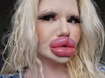 Woman with ‘world’s biggest lips’ gets filler on either side of nose to ‘even things out’