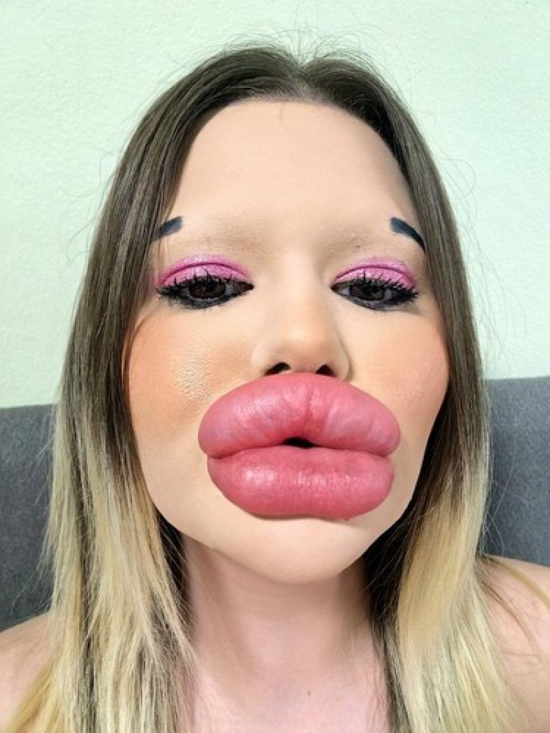 Woman with ‘world’s biggest lips’ gets filler on either side of nose to ‘even things out’