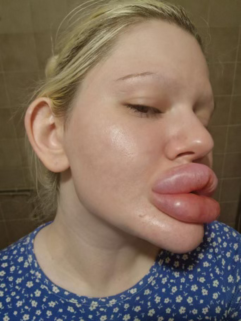 Woman with ‘world’s biggest lips’ gets filler on either side of nose to ‘even things out’