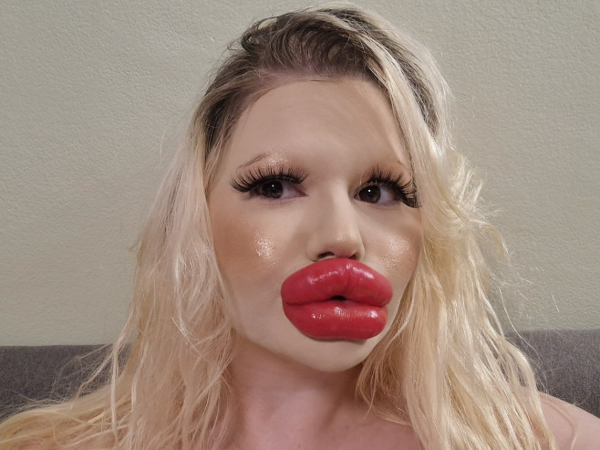 Woman with ‘world’s biggest lips’ gets filler on either side of nose to ‘even things out’