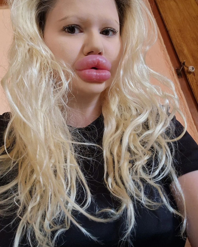 Woman with ‘world’s biggest lips’ gets filler on either side of nose to ‘even things out’