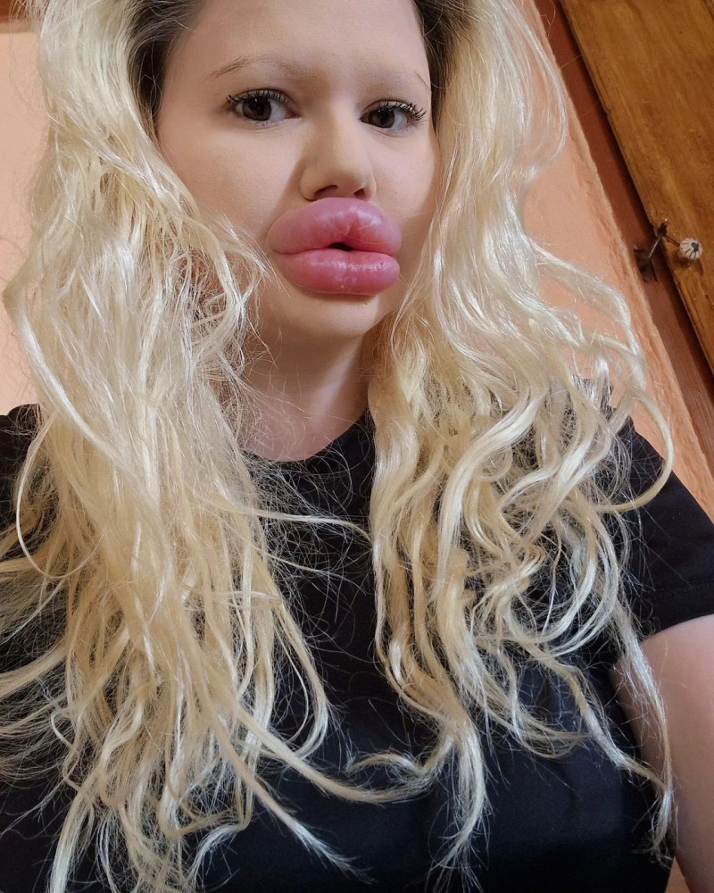 Woman with ‘world’s biggest lips’ gets filler on either side of nose to ‘even things out’