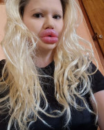 Woman with ‘world’s biggest lips’ gets filler on either side of nose to ‘even things out’