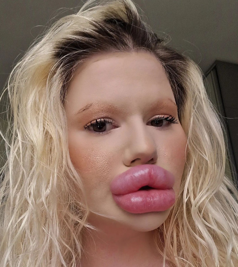 Woman with ‘world’s biggest lips’ gets filler on either side of nose to ‘even things out’