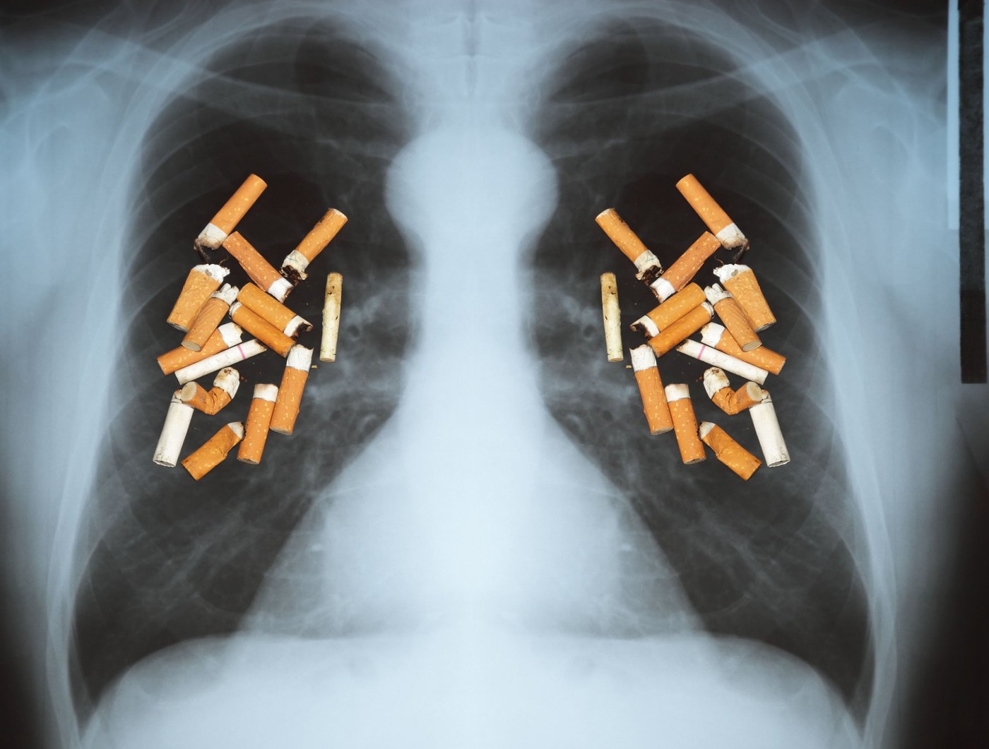 Avertismentul dur al unui medic pneumolog: „În fiecare oră, cel puţin, un român moare de cancer”