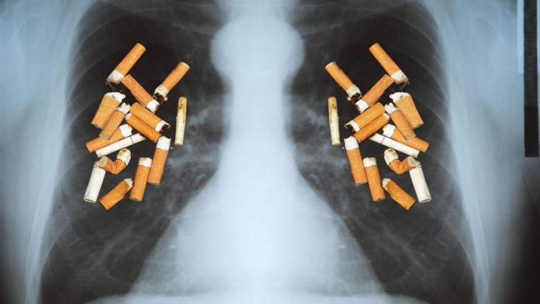 Effects of cigarette smoking - lung cancer.