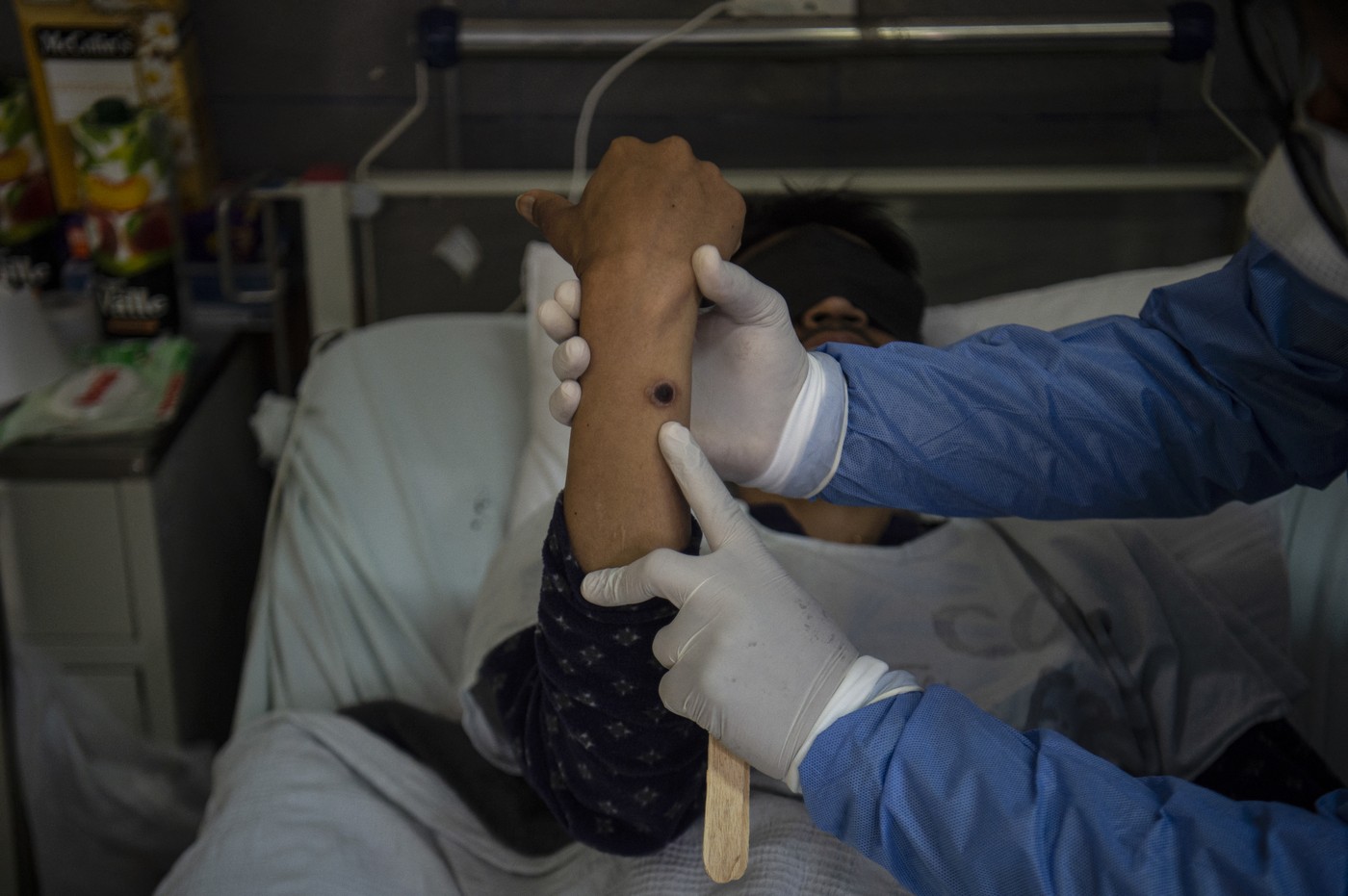 Primul caz de variola maimuței în Europa. Avertismentul dr. Adrian Marinescu: Noua tulpină mpox poate pune probleme